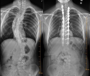 Spinal Fusion Before And After